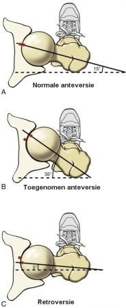 fracture anteversion femur femoral torsion femorale excessive arthroplasty psoas retroversion fixation ortopedia traumatologia anatomic technique  anatomie physiology podiatry radiology